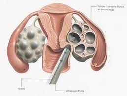 Ovulation Induction,Ovulation Induction Infertility Treatment India